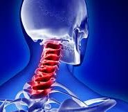 thoái hóa đốt sống cổ